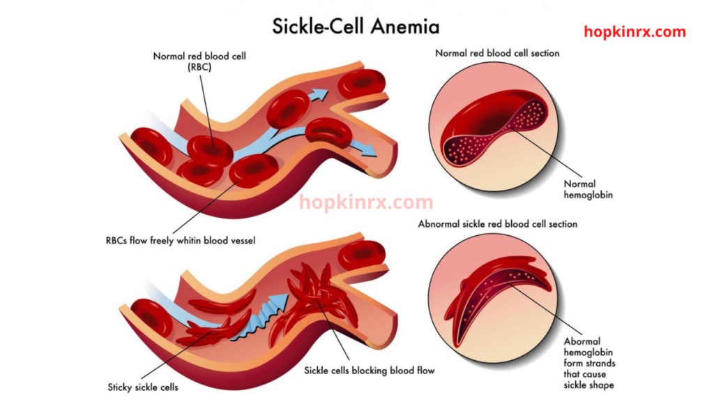 Anemia 3