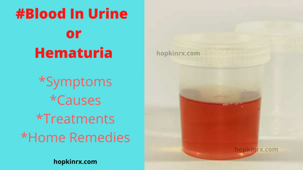 Blood-In-Urine-or-Hematuria