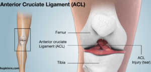 ACL INJURY