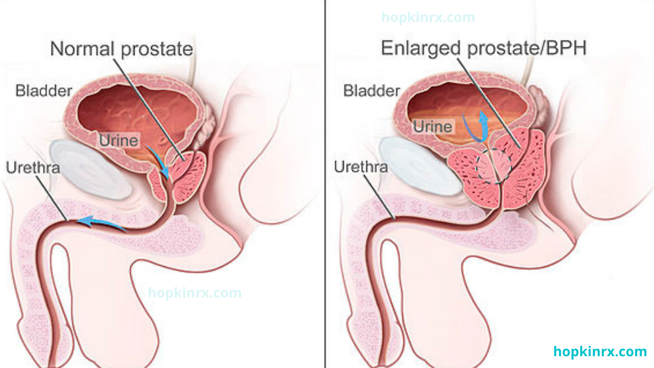prostatitis