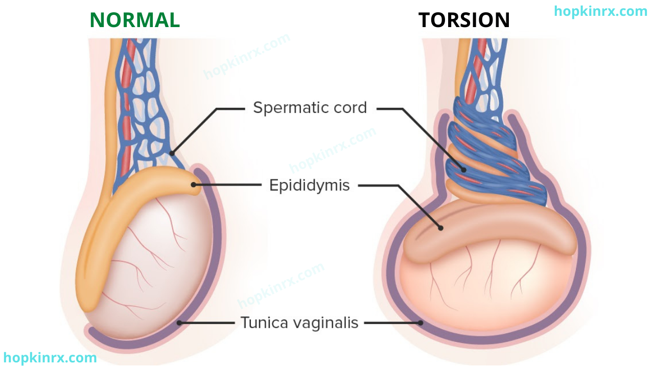 Testicular torsion