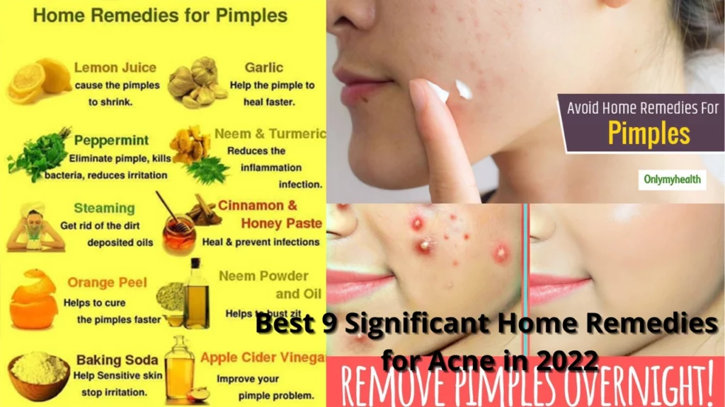 Best-9-Significant-Home-Remedies-for-Acne-in-2022