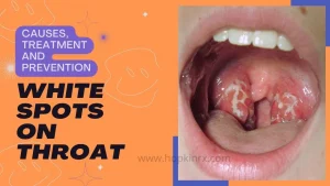 White Spots On Throat