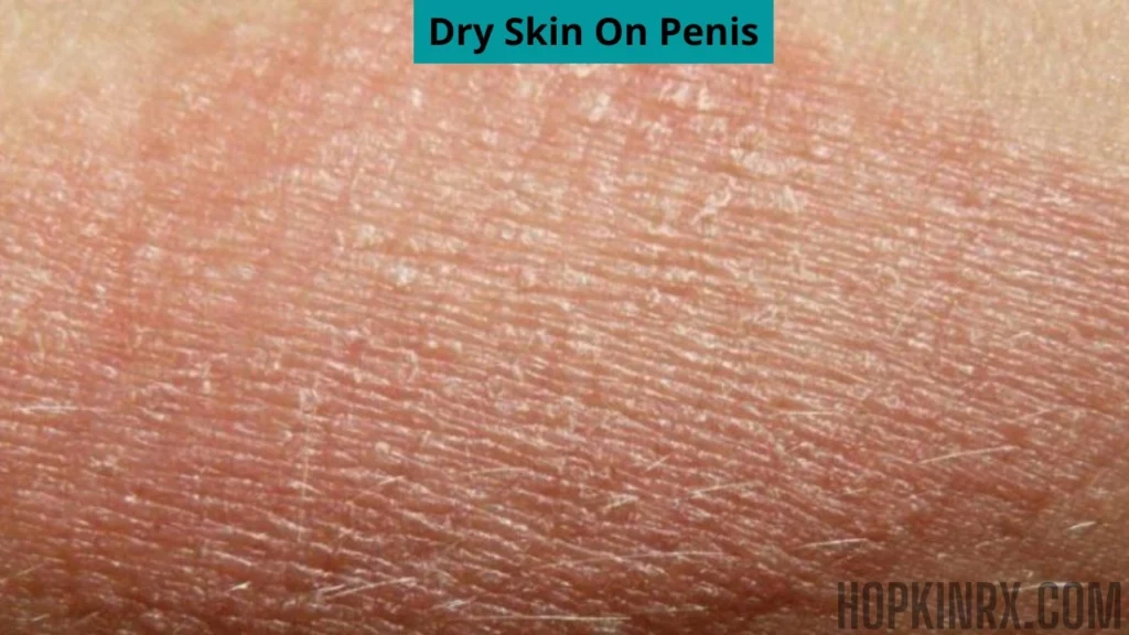Dry skin on penis