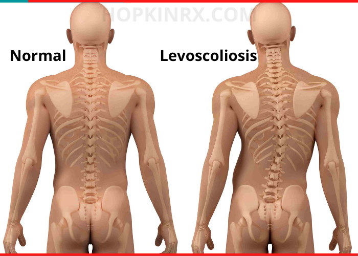 Levoscoliosis