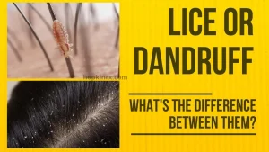 Lice or Dandruff
